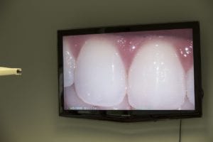 Teeth stills showing on tv screen   j David cross dds
